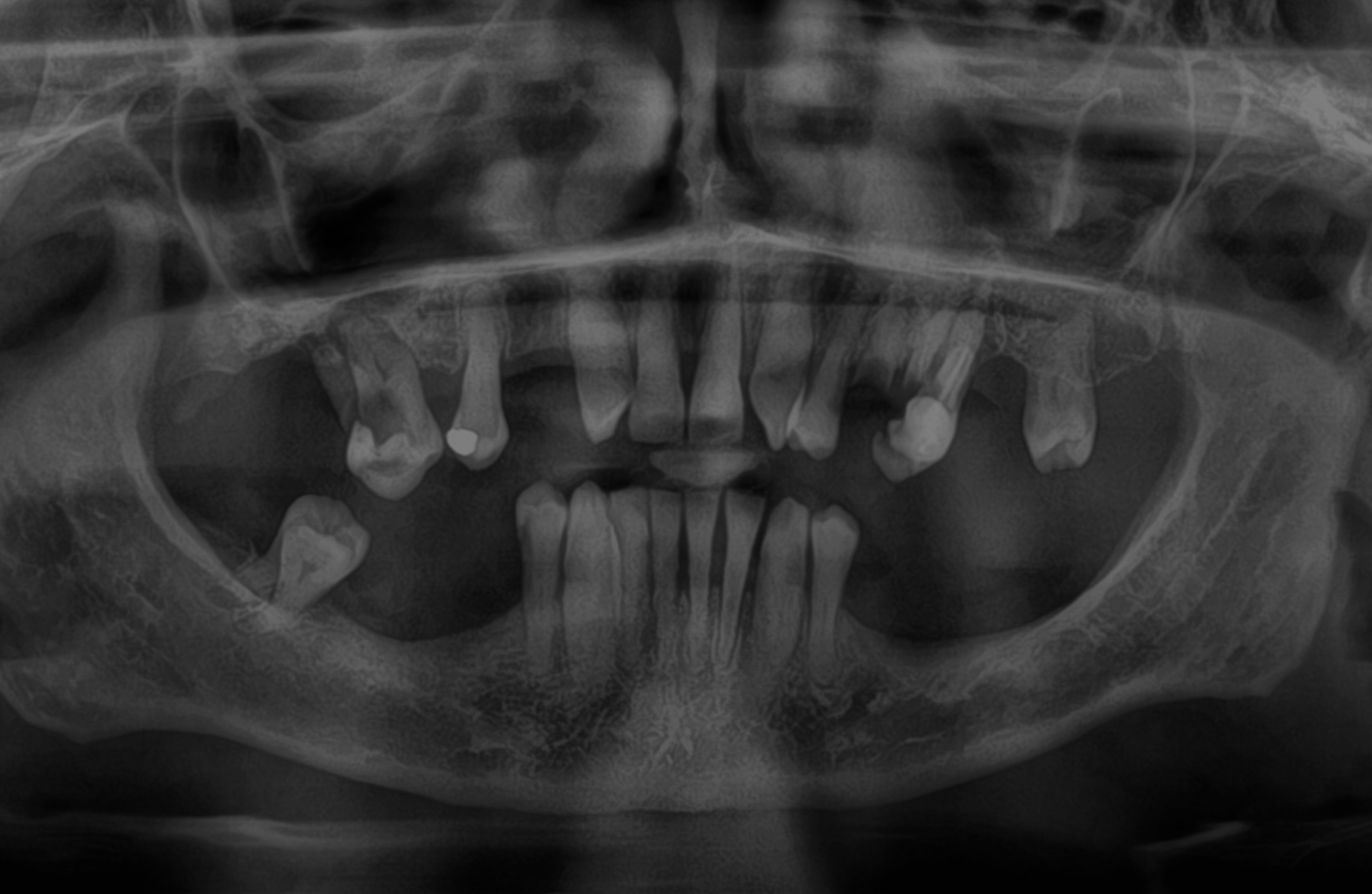  Antes de implantes cigomáticos 