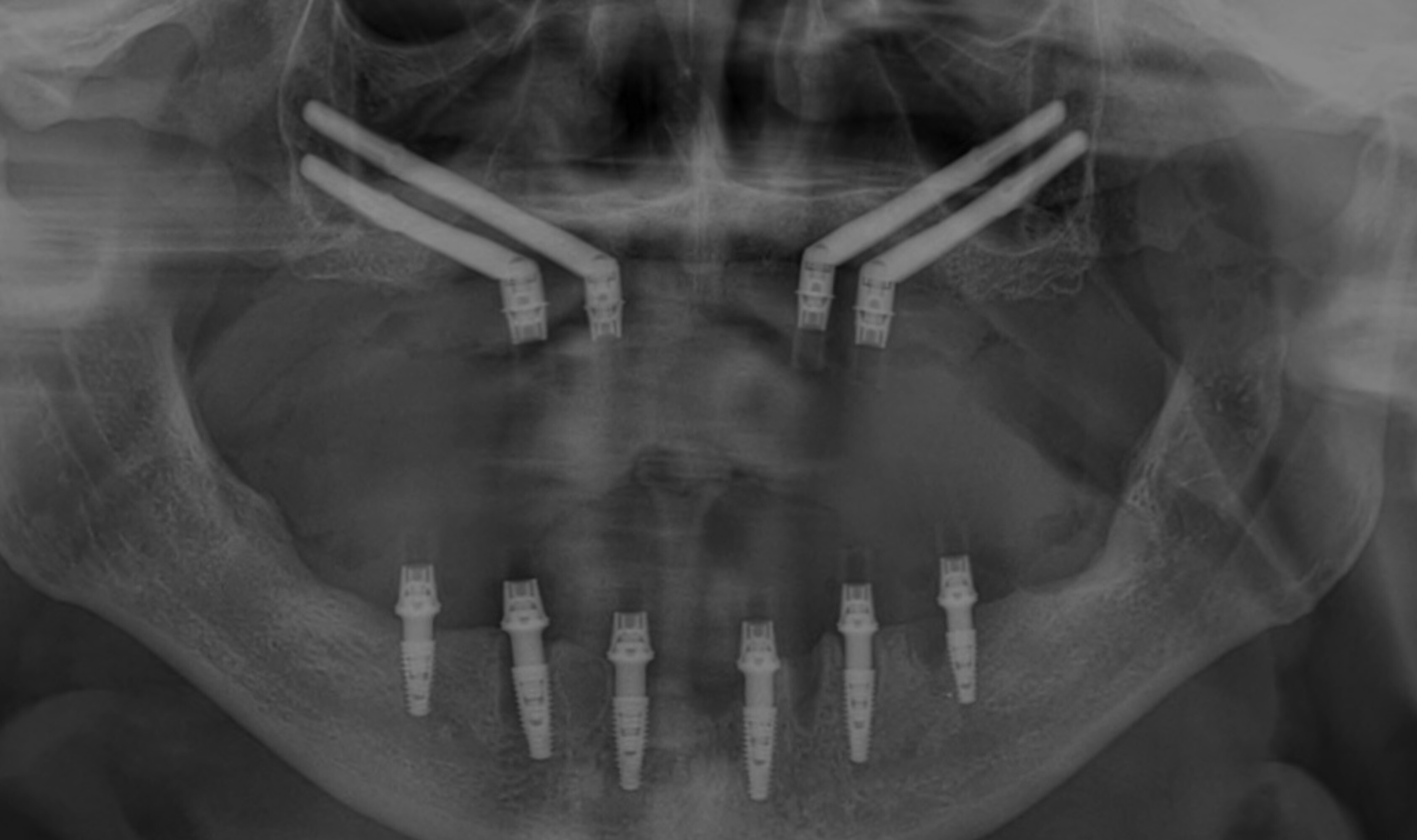  Después de implantes cigomáticos 